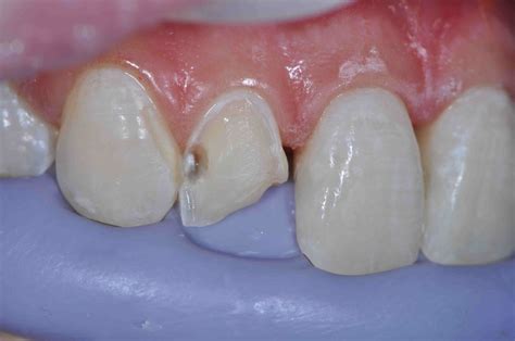Comparing Translucency Composite And Natural Teeth Lee Ann Brady Dmd