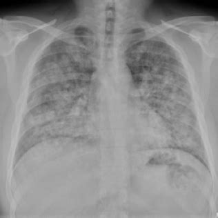 A foreign body in the urinary. Goodpasture's Syndrome with Negative Anti-glomerular ...