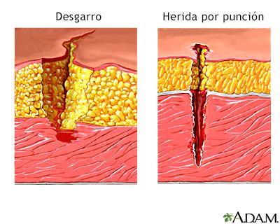 Spanish Hie Multimedia Desgarro Versus Herida Penetrante