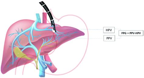 Scheme 1 Eus Guided Portal Pressure Gradient Ppg Measurement Ppg Is