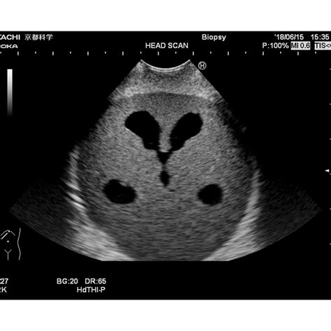 Ultrasound Neonatal Head Phantom Abnormal Type Kyoto Kagaku
