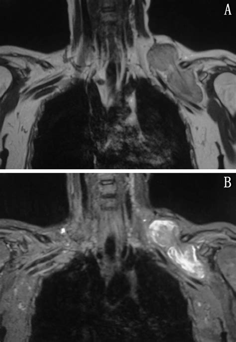 Axial Cta Showing Subclavian Vascular Compression Caused By The Mass