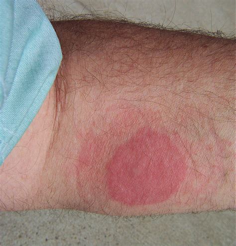 Identify Bed Bug Rash And How To Treat The Bites And Itch