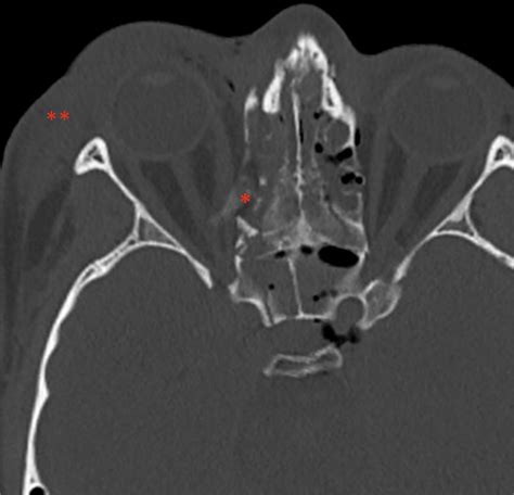 Computed Tomography Scan Showing Right Sided Proptosis Comminuted