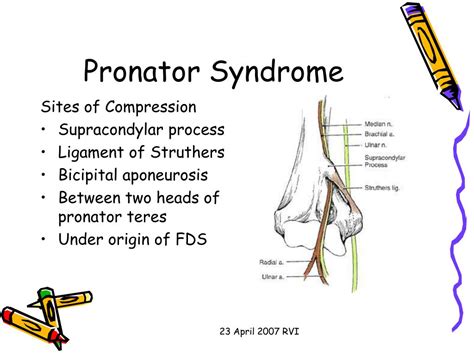 Ppt Median Nerve Compression Syndromes Powerpoint Presentation Id