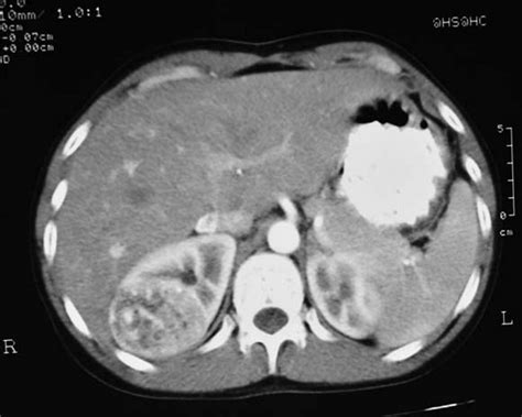 Ultrasound And Ct Imaging Assessment Of Renal Angiomyolipoma Bmj Case Reports