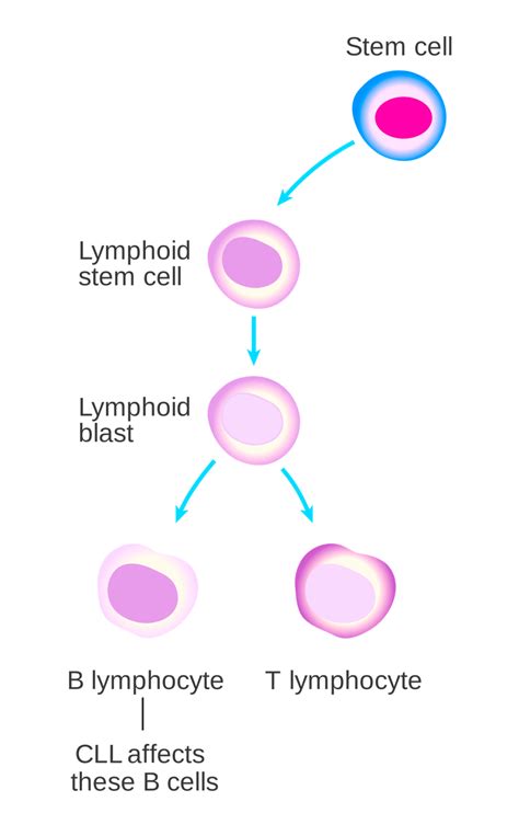 Overview Of Chronic Lymphocytic Leukemia Storymd