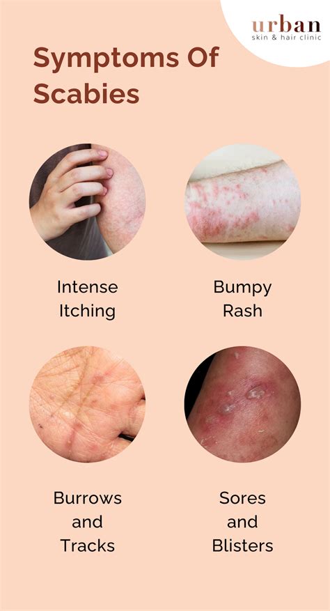 Scabies Types Causes Symptoms And Treatment Ushc