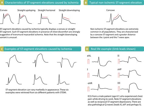 Ecg Interpretation Characteristics Of The Normal Ecg P Wave Qrs