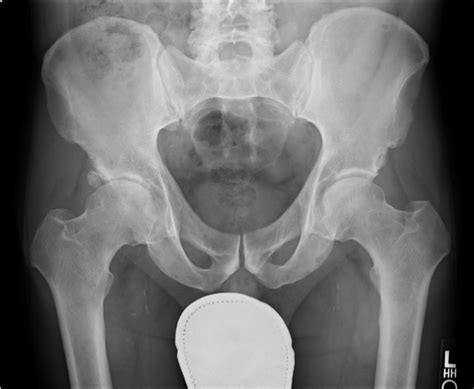 Even with bone cancers comprising less than 1% of all types of cancers, the american cancer society still estimates that 1,720 deaths from 3,200 new cases of bone cancer will occur in 2020. HIP CANCER | buyxraysonline