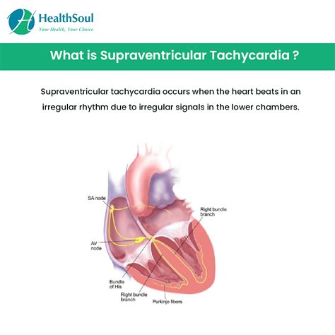 Supraventricular Tachycardia Causes Symptoms And Treatment Healthsoul