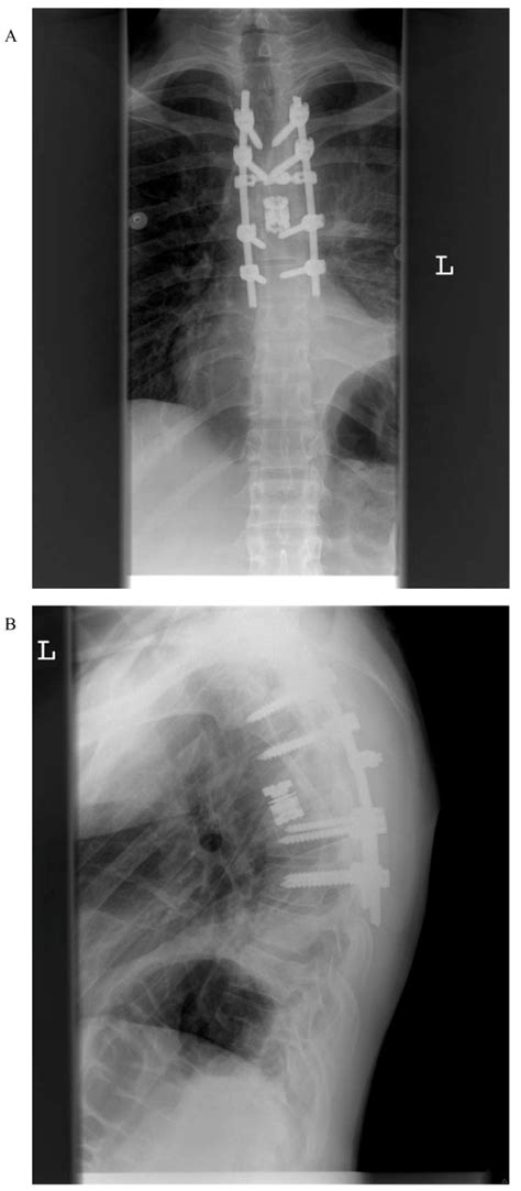 Post Operative Standing Thoracic Spine X Rays A Ap And B Lateral