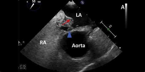 Atrial Septal Aneurysm Not Shunt Size Tied To Recurrent Pfo Related