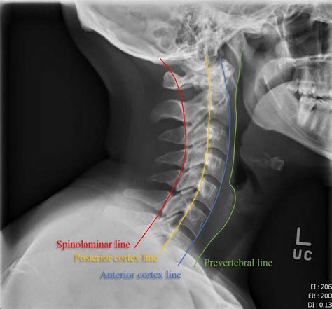 Cervical Spine Imaging In Trauma 2022
