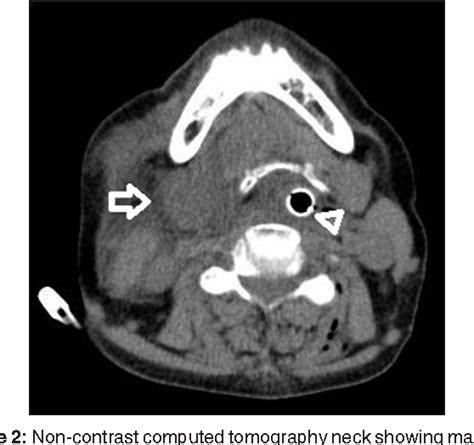 Figure 2 From Acute Unilateral Post Operative Submandibular