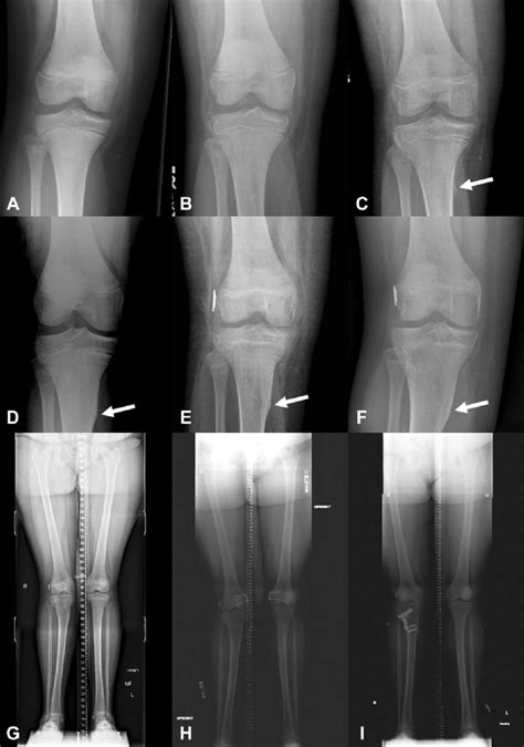 Knee Radiographs Of A 9 Year Old Girl With An Anterior Cruciate