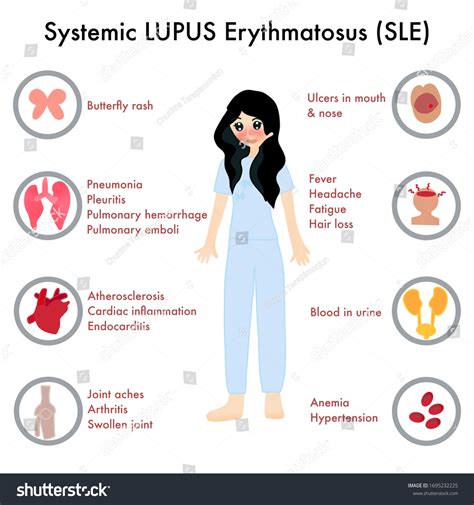 Symptoms Systemic Lupus Erythematosus Sle Including Stock Illustration