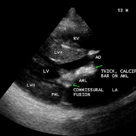 Parasternal Long Axis View Showing The Bicuspid Aortic Valve And