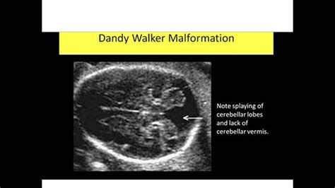 Dandy Walker Fetal Abnormalities Sonography Ultrasound Dandy Walker
