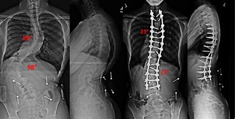Vertebral Column Resection Scoliosis And Spine Associates
