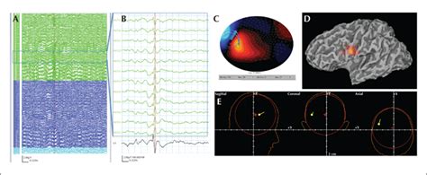 John Libbey Eurotext Epileptic Disorders Idiopathic Focal