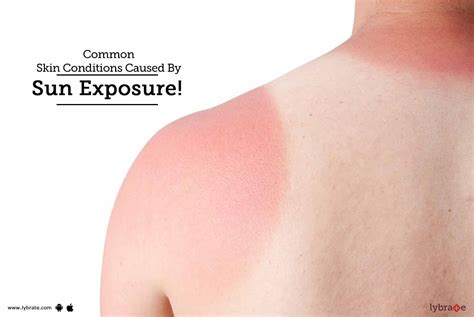 Common Skin Conditions Caused By Sun Exposure By Dr Ramesh Gosavi