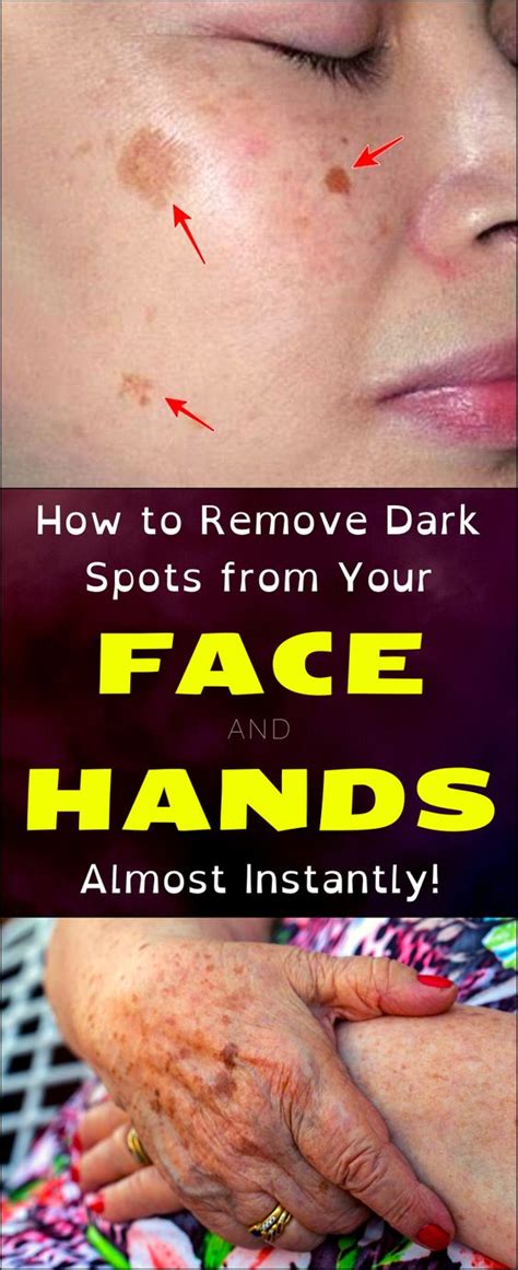 How To Remove Dark Spots From Your Face And Hands