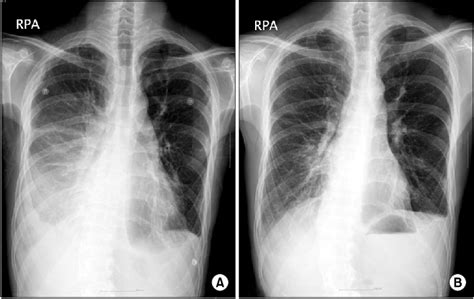 Causes of pleural effusion are generally from another illness like liver disease, congestive heart. (A) Chest PA (before treatment): loculated right pleural effusion. (B)... | Download Scientific ...