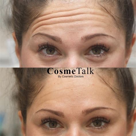 Botox Brow Lift Procedure Effectiveness Cost And Side Effects