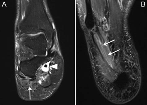 A Case Of Posterior Tibial Nerve Injury After Arthroscopic