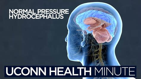 UConn Health Minute Normal Pressure Hydrocephalus YouTube