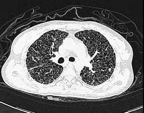 High Resolution Computed Tomography Thoraxwhich Showed Multiple Thin