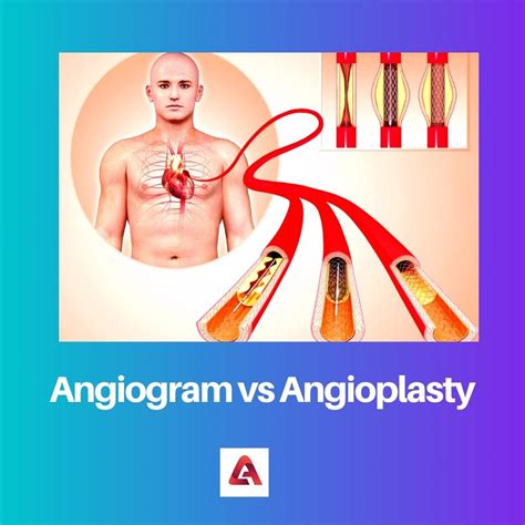 Difference Between Angiogram And Angioplasty