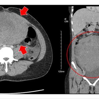 Computed Tomography Ct Of The Abdomen And Pelvis Revealing Solid