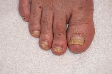 What Is Toenail Fungus And How Do You Deal With It Howard County