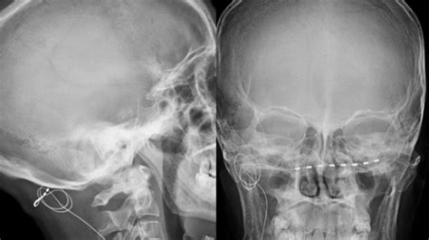 Lateral And Anteroposterior X Ray Images Of The Occipital Electrode