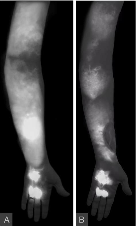 Vascularized Lymph Vessel Transfer For Extremity Lymphedema Is