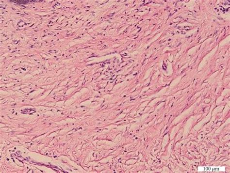 Multiple Vulvar Giant Fibroepithelial Polyps A Rare Case Occurrence