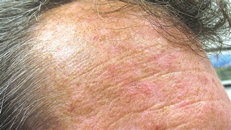 Skin Lesions 45 Causes With Pictures Types And Treatments