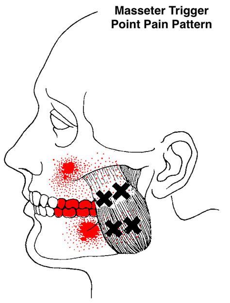 Pain In The Jaw TMJ Overview Treatment Bristol Massage Clinic