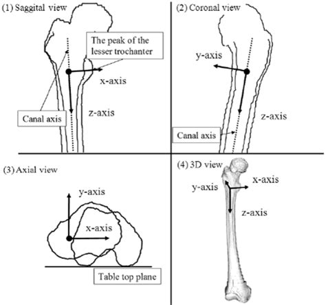 'for axial cuts, the tracheal diameter was measured in the sagittal and coronal planes. Definition of the femur coordinate system ((1) Sagittal ...