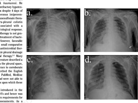 Serial Chest Radiographs A Day 24 Left Lung Consolidation And Large