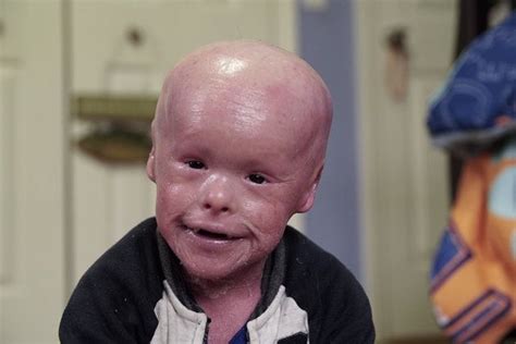 Five Year Olds Skin Grows At 10 Times The Normal Rate Ichthyosis
