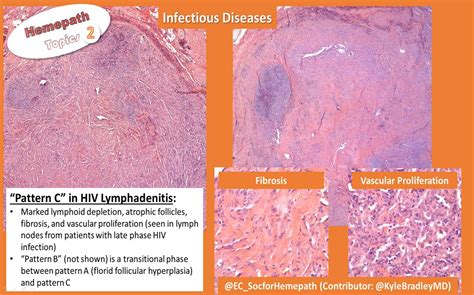 Here Is A Lymph Node That Is Lymphoid Depleted Fibrotic Grepmed
