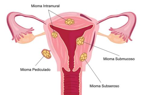 Os Tipos de Miomas Uterinos Clínica Ayroza Ribeiro