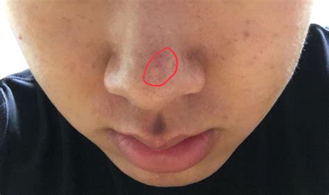 [Skin Concerns] How do I get rid of these skin colored bumps on my nose ...