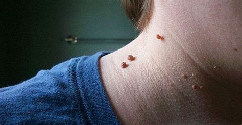 Ma rivolgersi a un medico assicura una eliminazione definitiva (e, certamente, più sicura). Elimina i fibromi penduli con un metodo facile e indolore!