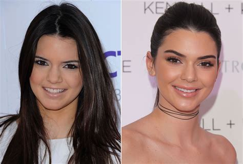Kendall Jenner Before And After Kendall Jenner Plastic Surgery Kendall Jenner Lip Injections