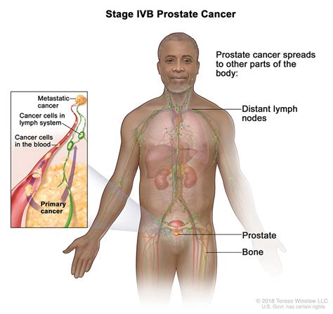 Prostate Cancer Staging Affiliated Oncologists