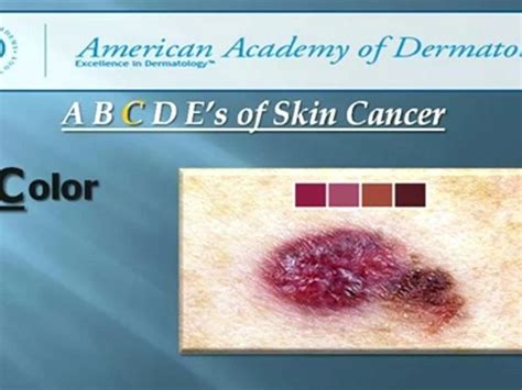 Abcdes Of Skin Cancer Detection All County Dermatology Video